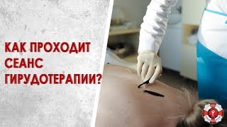 На сеансе гирудотерапии. Когда эффективно лечение пиявками?