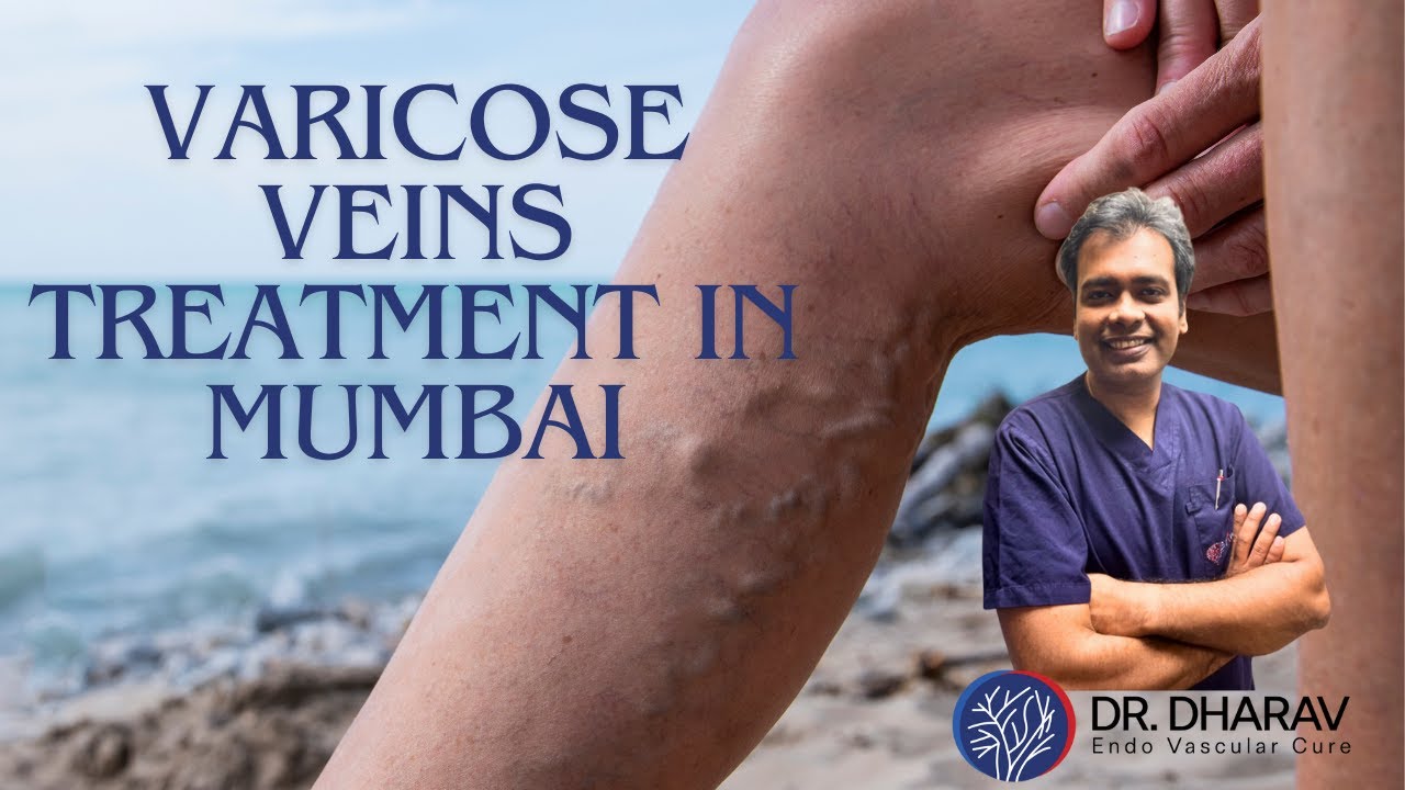 Varicose Veins Treatment in Mumbai