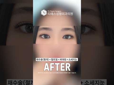 짝짝이눈 탈출 #재수술 #절개 #앞트임 #비대칭 #소세지눈