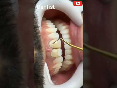 حشو الأسنان الامامية المسوسة  