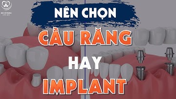 Nên Chọn Cầu Răng Hay Implant Khi Bị Mất Răng | Bác sĩ Trung Long Biên