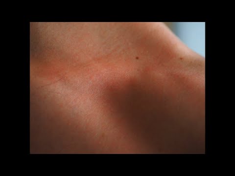 Best dermatologist near me for skin cancer (747) 229-0885 | Skin cancer screening