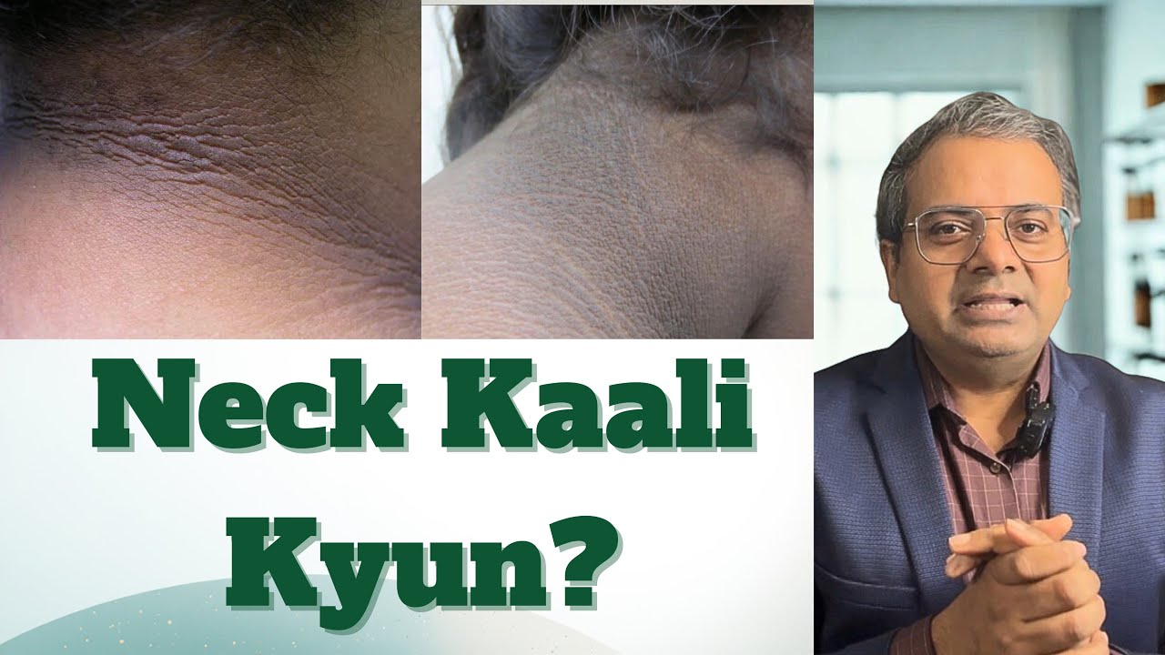 Niagran Rash Acanthosis Nigricans | Neck Darkening & Insulin Resistance ...