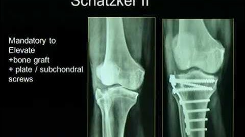 Tibial Plateau Fractures