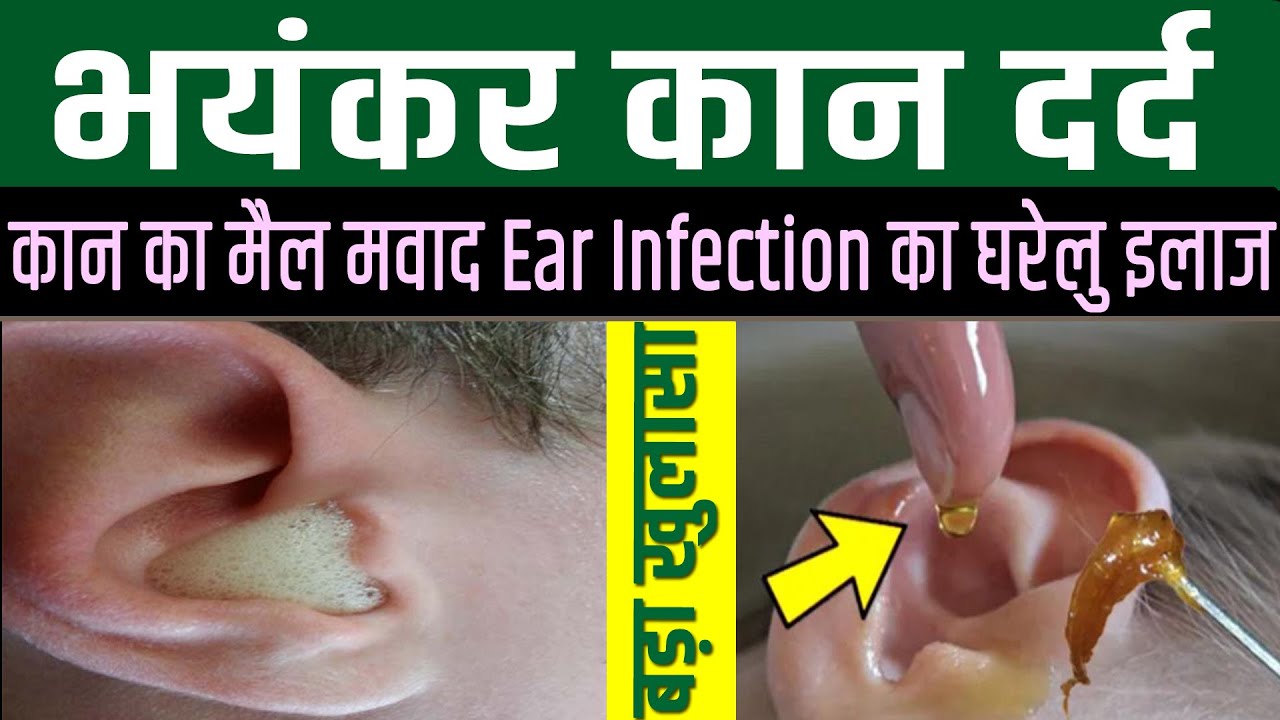 2 बूंद डालते ही कान दर्द बिलकुल ठीक कान का मैल मवाद Ear Infection का