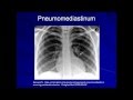 Lung Protective Ventilation (Mechanical Ventilation - Lecture 9)