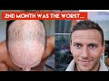My hair transplant journey  the awful first 4 months indepth walkthrough week by week
