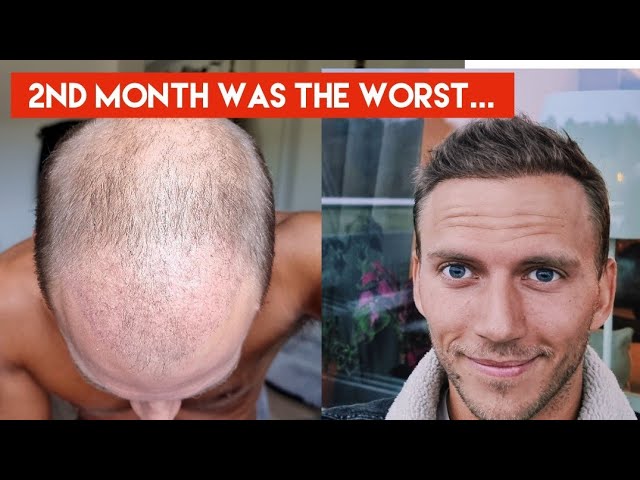 Why Does My Hair Itch After A Hair Transplant? - Este