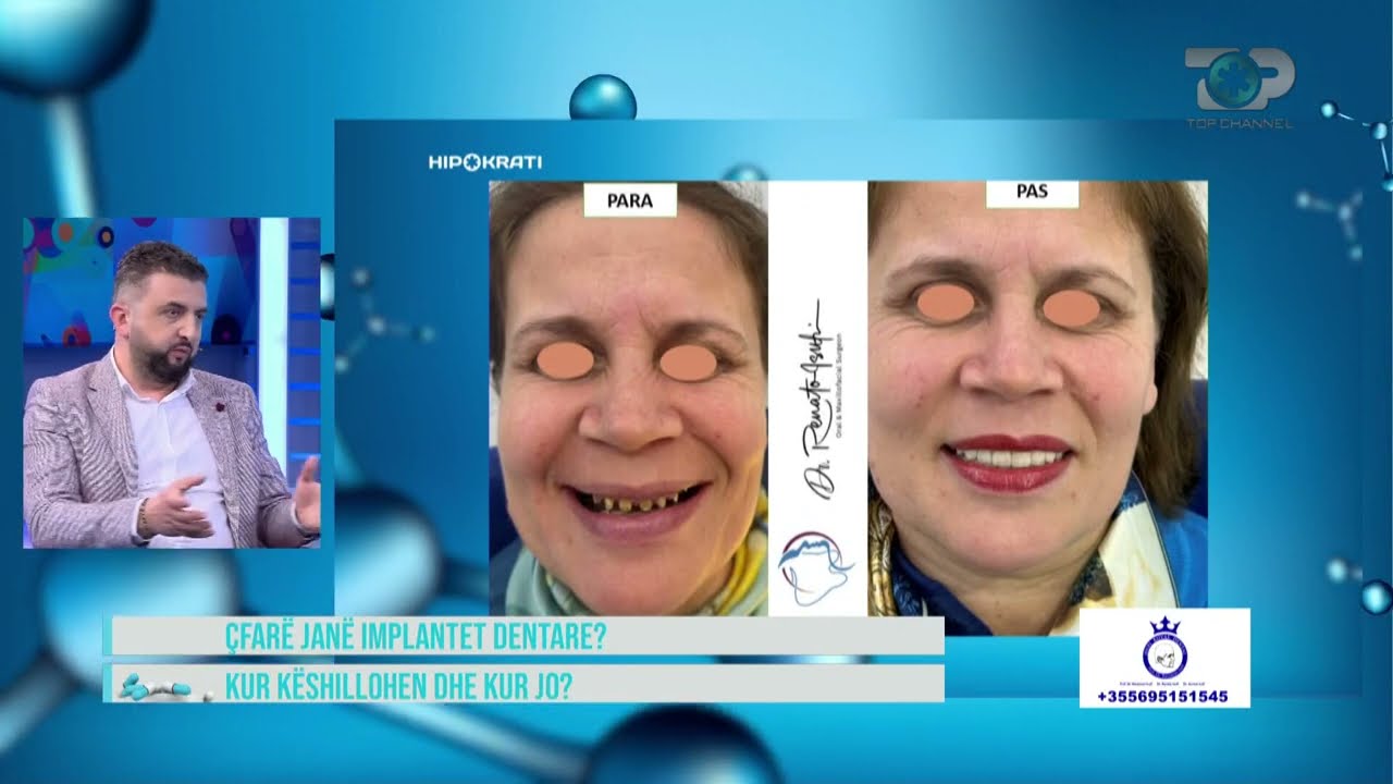 Hipokrati - Implantet dentate, kur këshillohen dhe sa zgjat vendosja e tyre