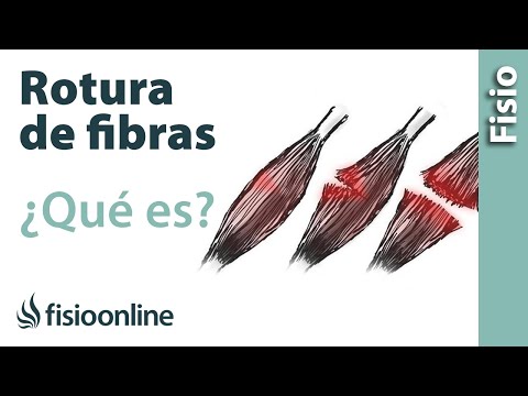 Video: 4 formas de tratar un dedo roto