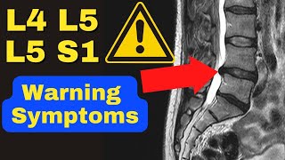 WARNING: These Are The 3 MAJOR Symptoms of a Severe L4 L5, L5 S1 Disc Bulge! | Dr. Walter Salubro