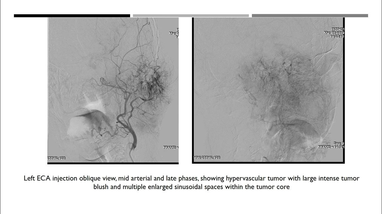 Percutaneous nBCA glue embolization of skull base tumor YouTube