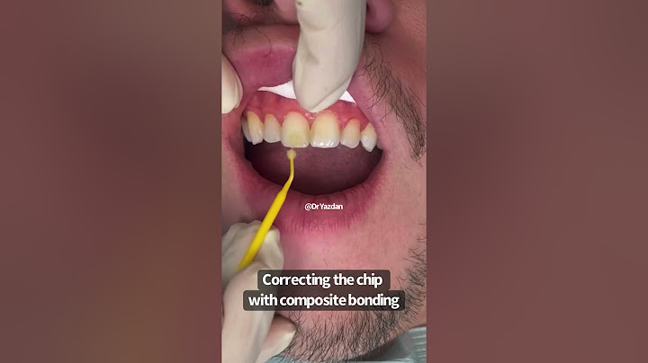 Fixing a chipped front tooth | composite bonding | Cosmetic Dentist Dr Yazdan