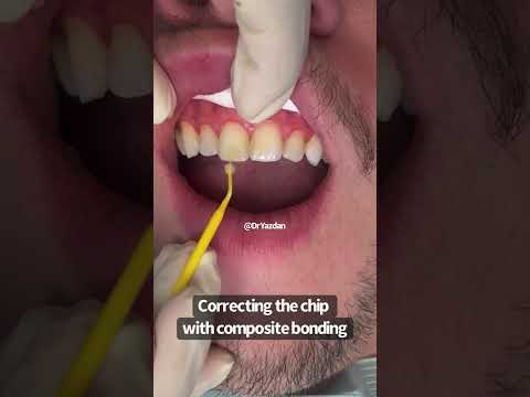 Wideo: Czy dentyści naprawiają wyszczerbione zęby?