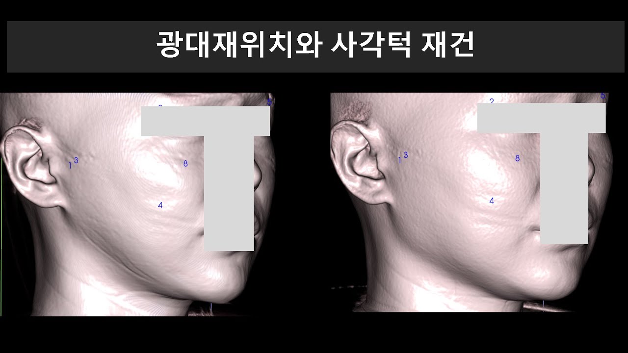 광대재위치와 사각턱 재건 ( Zygoma Repositioning and Mandibular Angle Reconstruction using autogenous bone)