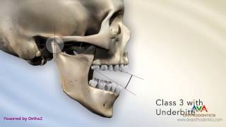 Malocclusion - Underbite or Crossbite Secondary to Short Maxillary Height