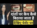 दांतों में कैप कैसे लगाया जाता है देखे पेशेंट पर |Teeth Capping Process Step By Step On Patient