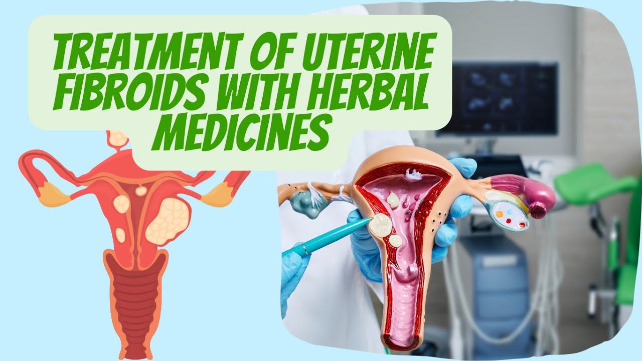 Definitive treatment of uterine fibroid with herbal medicines, without