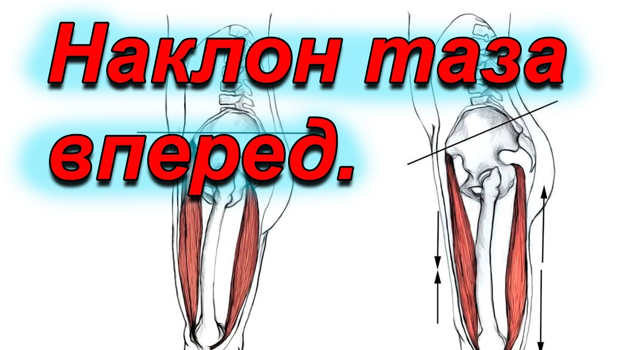 Гиперлордоз поясницы .Как устранить.Показываю практически.Остеопатия ...