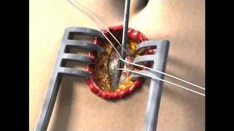 Diagnostic Peritoneal Lavage