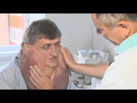 Teenager with football-sized tumour - Mirror Online