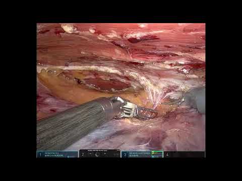 Robotic TARUP (Robotic Transabdominal Retromuscular Umbilical Prosthetic Hernia Repair)
