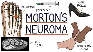 Morton’s Neuroma