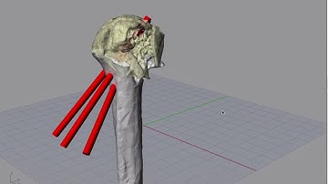 3D Planning Proximal Humeral Fracture with pins