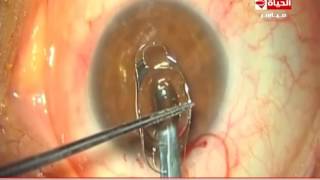 العيادة - د/إيهاب سعد أستاذ جراحات العيون - فيديو يوضح كيف يتم زراعة عدسة العين - the clinic