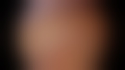 Partial Nephrectomy,- By DR V Chandra mohan