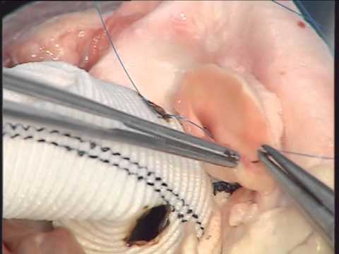 Aortic Root Replacement With Coronary Buttons Cardiac Surgical Skills Laboratory Advanced Skills