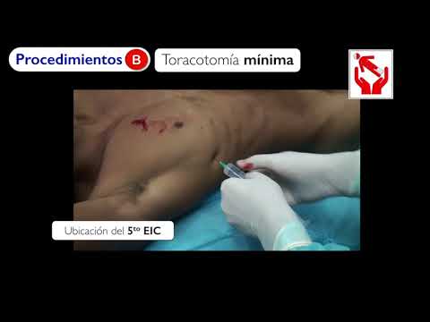 Video: ¿Cómo se realiza una toracotomía?