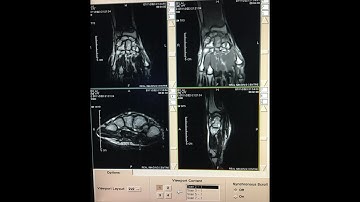 MRI Scan of Wrist Joint