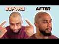 TJ Gets Scalp Micropigmentation in New York