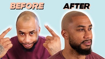 TJ Gets Scalp Micropigmentation in New York