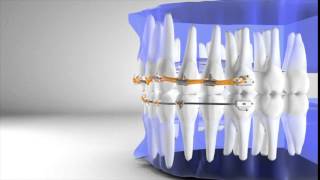 Fastbraces Technology Spaces With Overbite