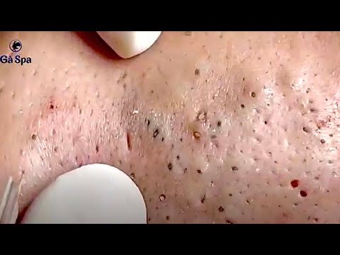 Super Blackheads Part 2 | Ga Spa| 07.02.2022