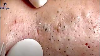 Super Blackheads Part 2 | Ga Spa| 07.02.2022 screenshot 1