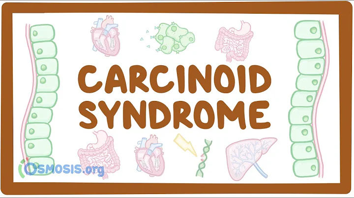 Carcinoid Syndrome - causes, symptoms, diagnosis, treatment, pathology