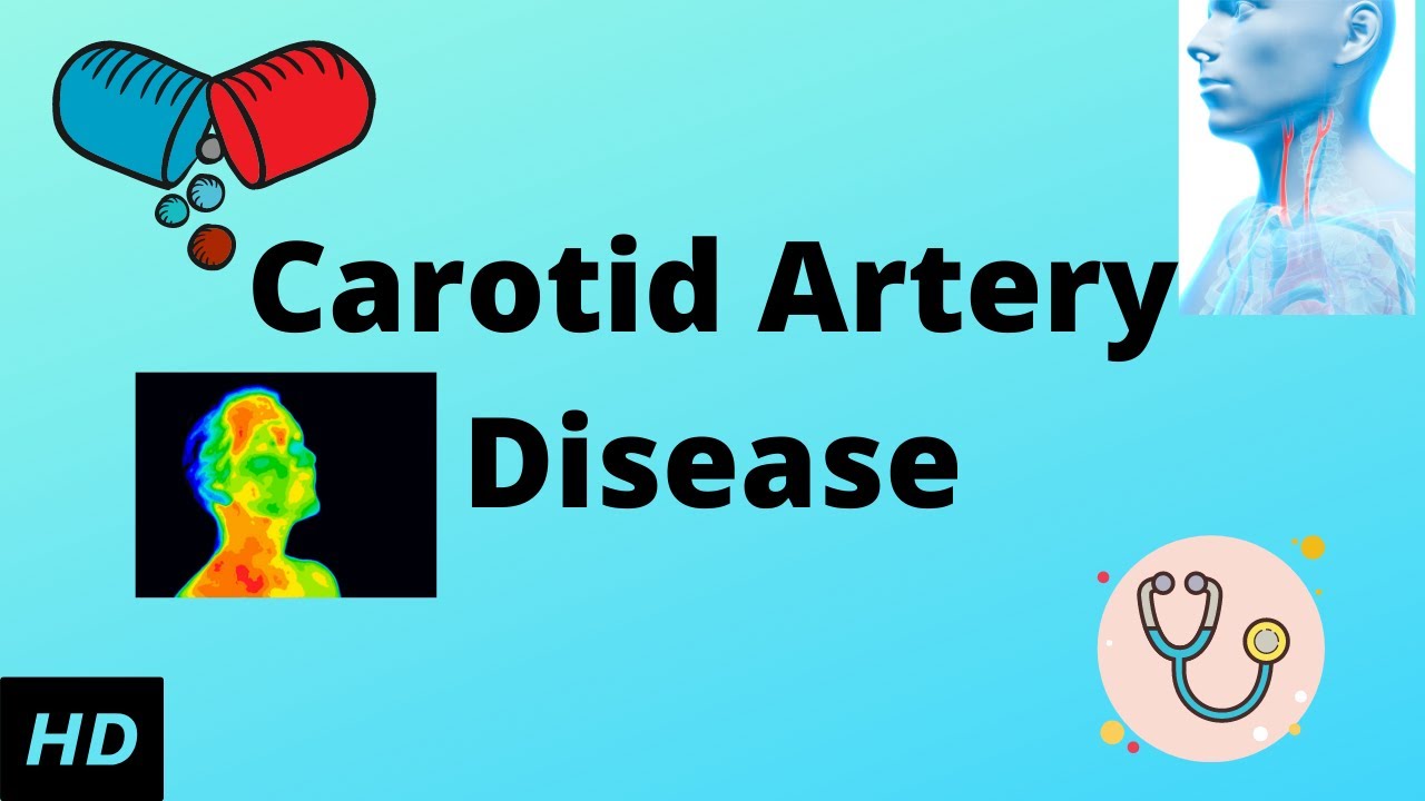 Carotid Artery Pain Symptoms carotid-artery-pain-symptoms