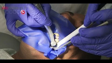 Comment détecter une fissure dentaire ?