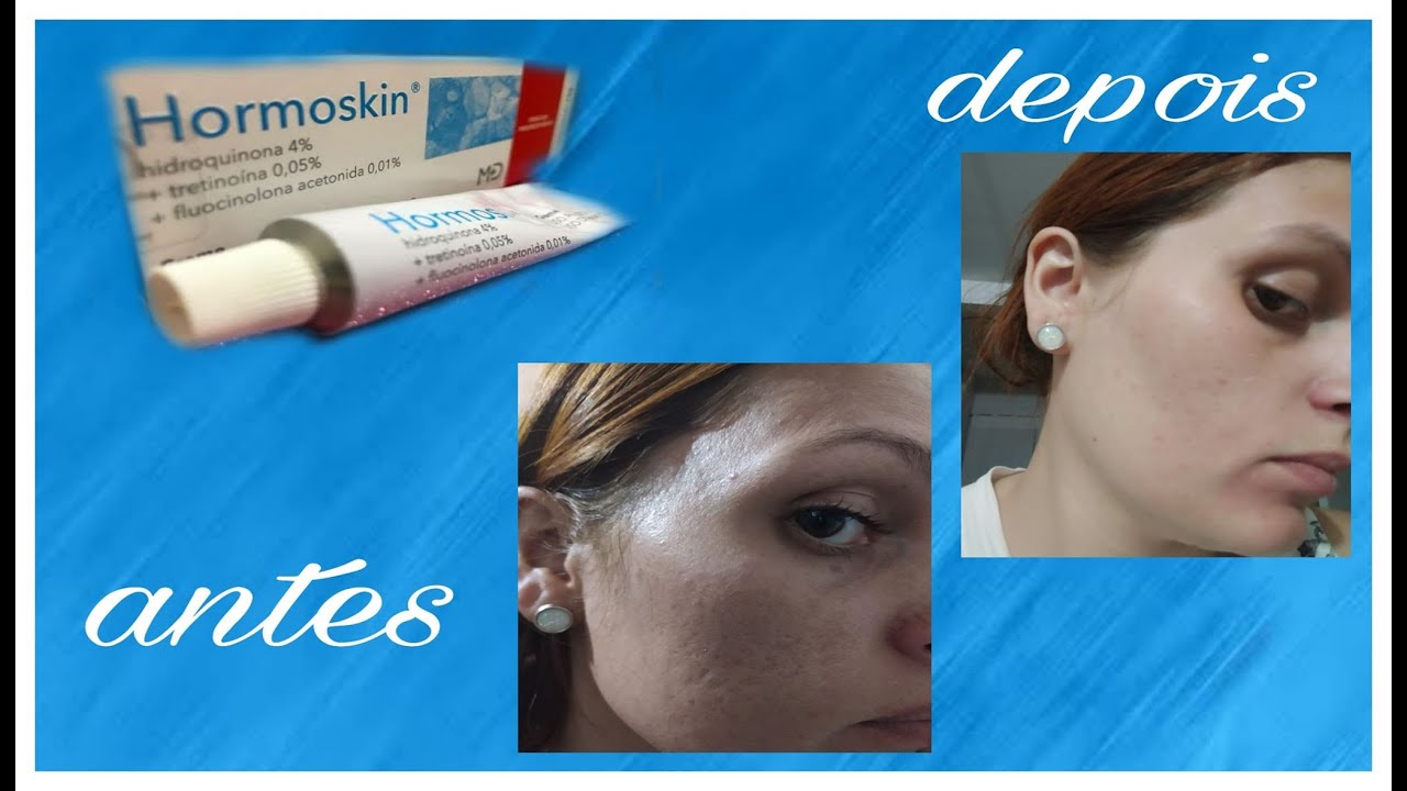 Clareando Melasma, manchas Acne. YouTube