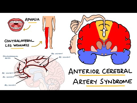 Anterior Cerebral Artery Stroke Syndrome -  ACA Stroke Syndrome | Stroke Syndromes