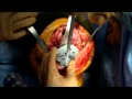 LEGION* Hinge Knee Surgery Live Video