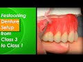 Festooning Denture Setup from Class 1 to Class 3