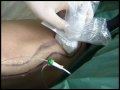 Locclusion endoveineuse par laser evlo avec venex de kls martin part 2