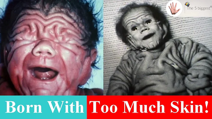 Australian Born With Too Much Skin: Watch Tomm Tennent Transformation! ~ Body Bizarre! - DayDayNews