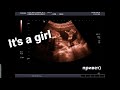 Видео Узи Беременность 20 недель. It's a girl! Pregnancy حملٌ Schwangerschaft embarazo gravidanza