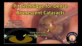 Pit Technique for Dense Brunescent Cataract Surgery Success