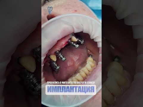 Прижились 8 имплантов на верху и 4 внизу. 8 implants at the top and 4 at the bottom.